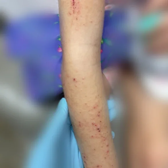 Before: rash on the arm before treatment