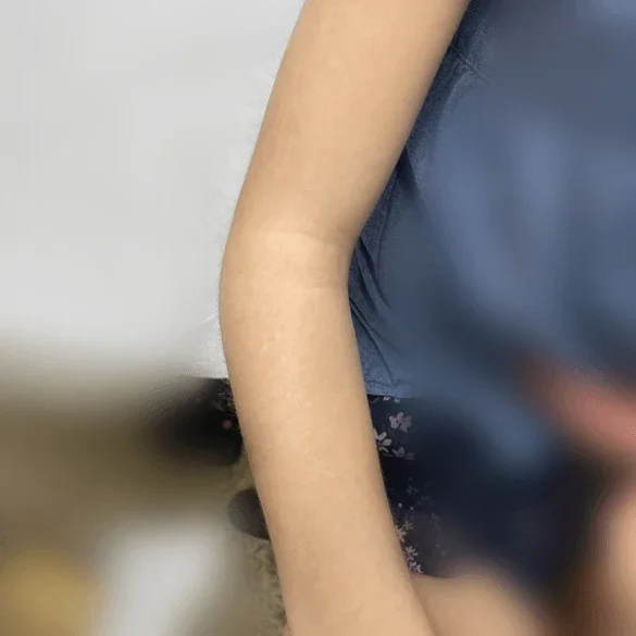 After: arm after treatment