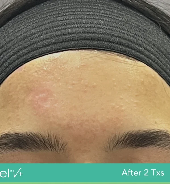 After: forehead after 2 excel V+ treatments