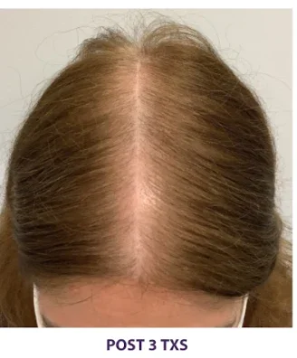 After: hair at the part after 3 TED treatments
