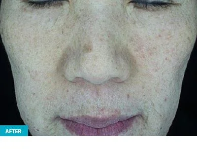 After: face after DermaV