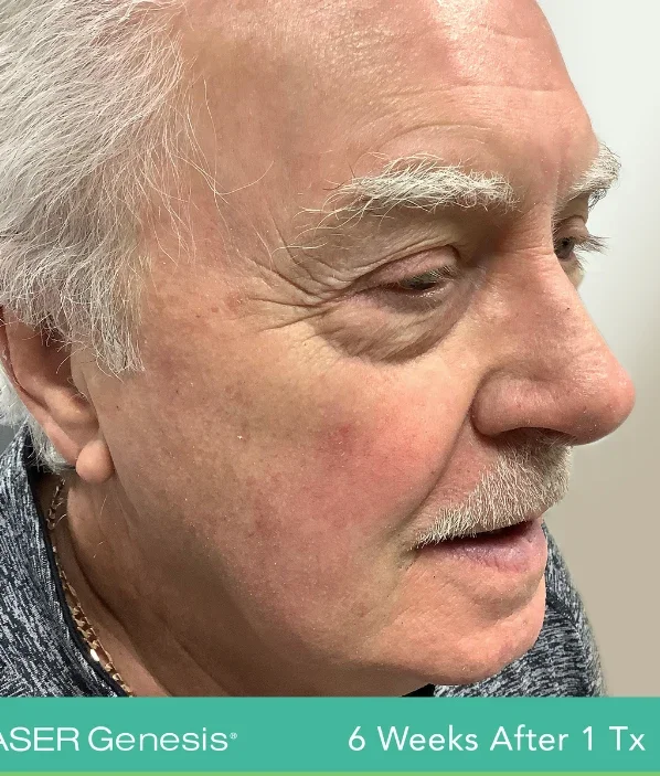 After: face 6 weeks after 1 excel V+ treatment, side view
