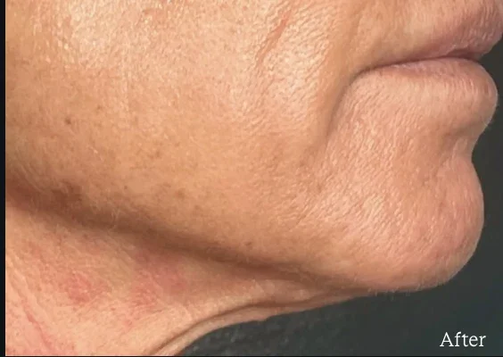 After: lower face and jawline after Density RF