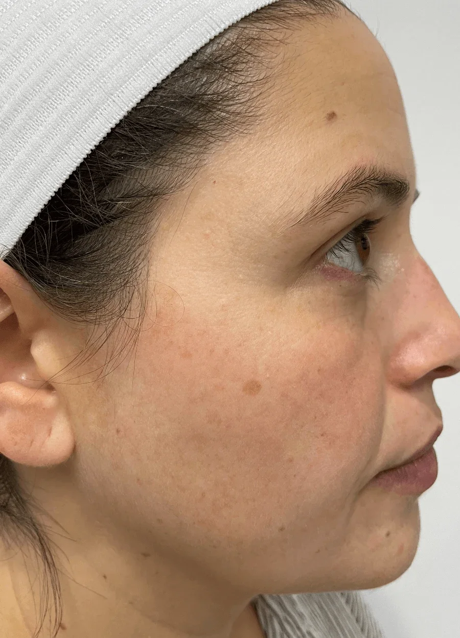 After: cheek and jawline after Morpheus8, side view