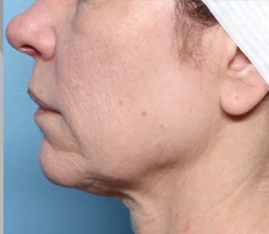 After: neck and jawline after XERF, side view