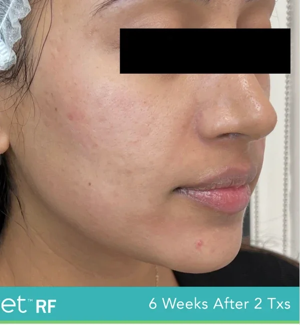 After: cheek 6 weeks after 2 SecretRF treatments