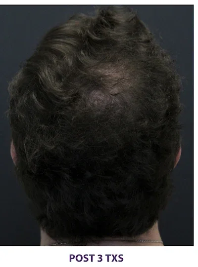 After: crown after 3 TED treatments