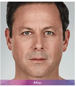 After: man's face after Juvederm filler, front view
