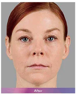 After: woman's face after Juvederm filler, front view