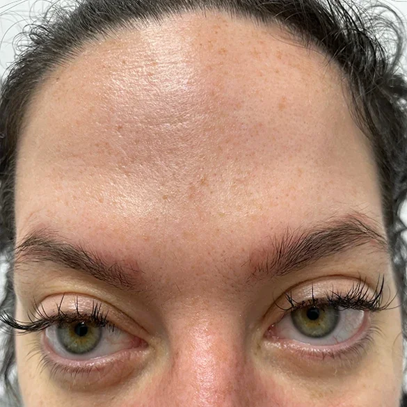 After: forehead after Botox, front view