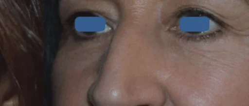 After: lower eyelids after AccuTite