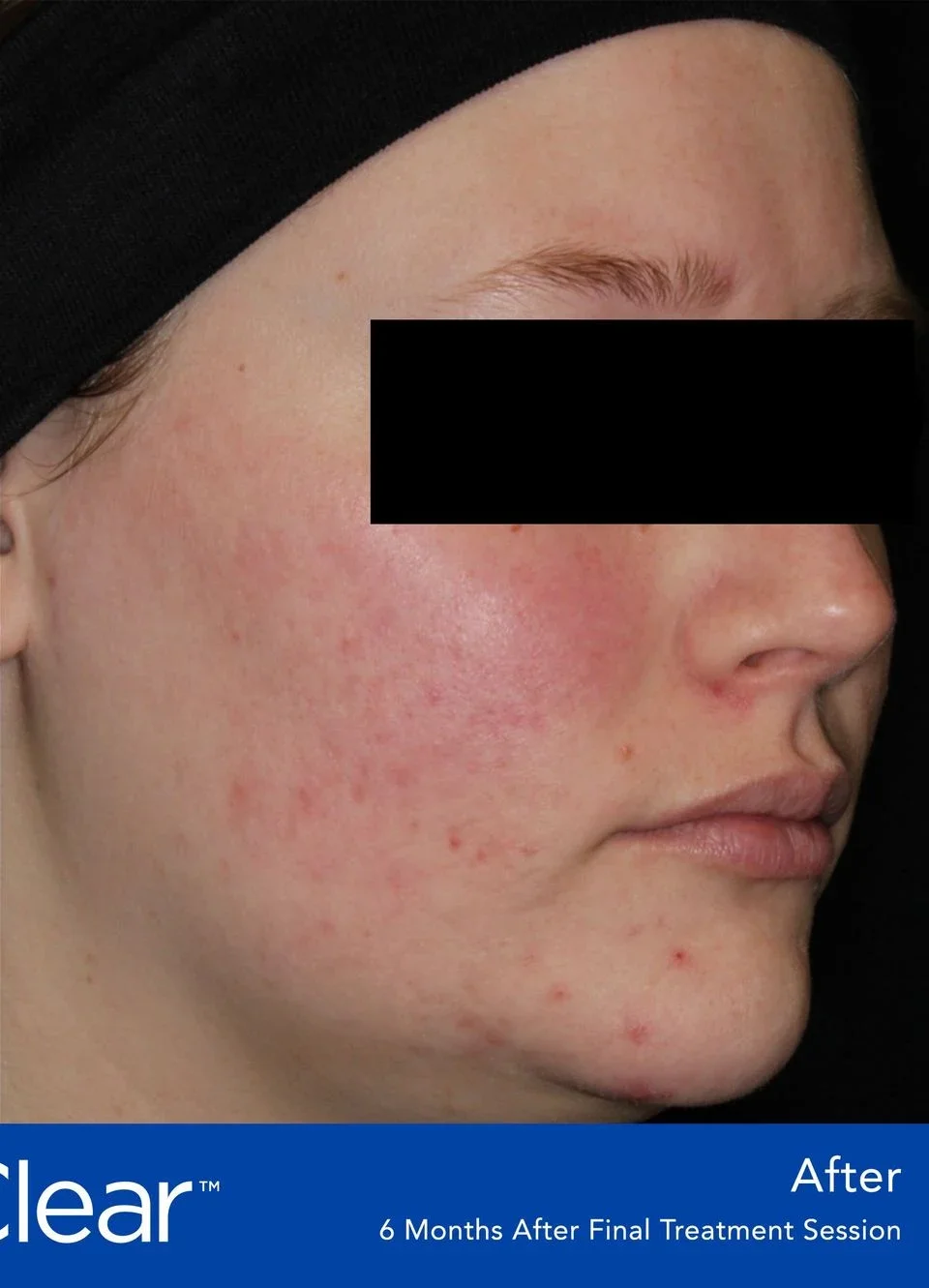 After: cheek after AviClear