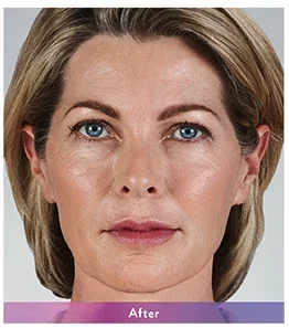 After: woman's face after Juvederm filler, front view