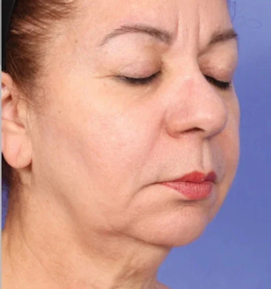 After: jawline and neck after XERF, three-quarter view