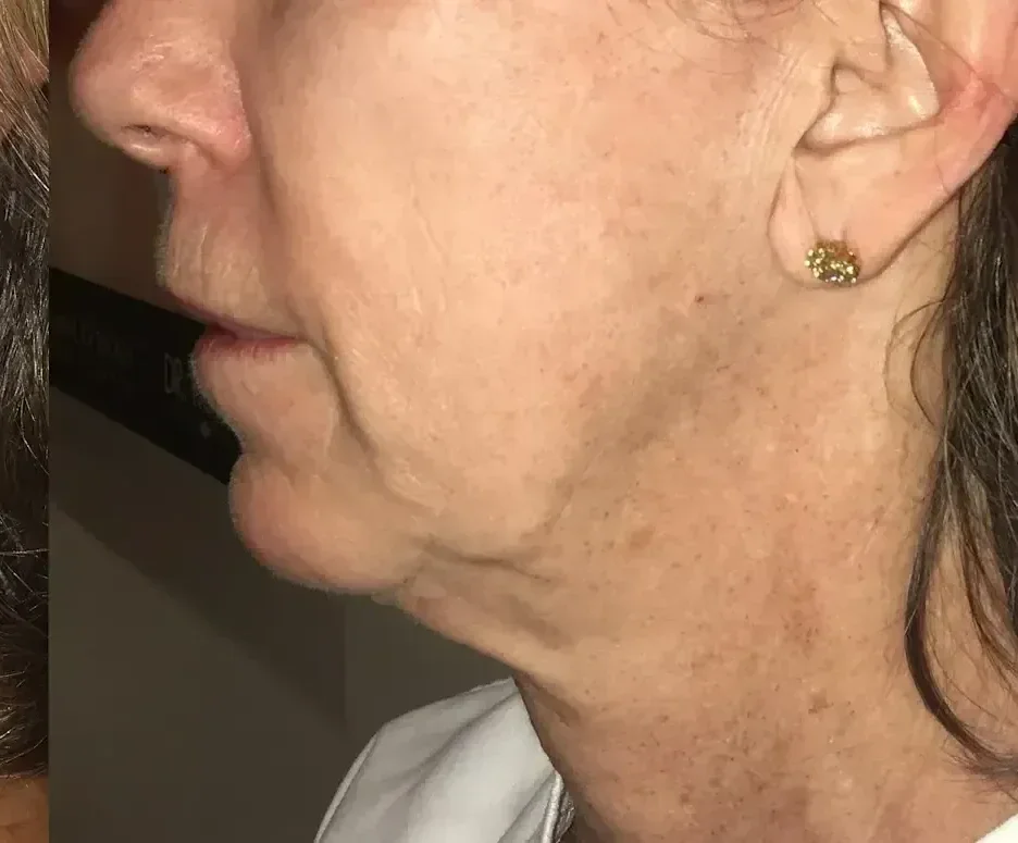After: neck and jawline after Morpheus8, side view