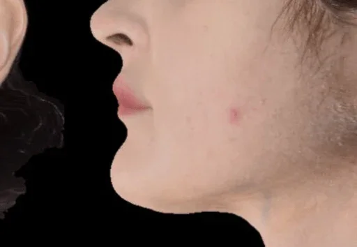 After: under the chin after AccuTite, side view