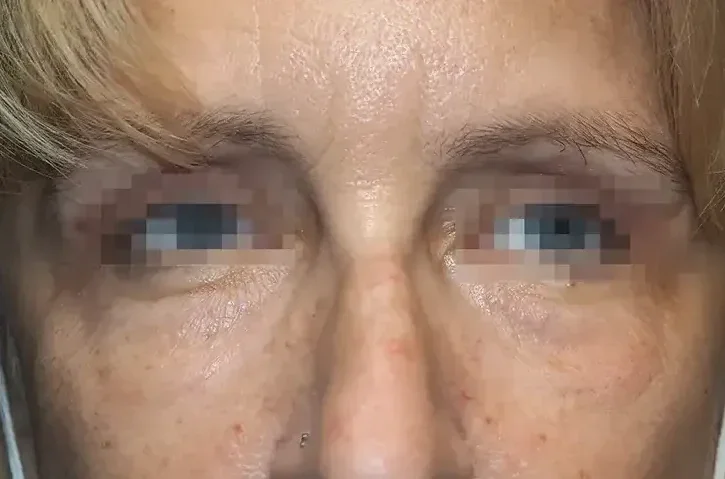 After: under-eye area after Morpheus8 Prime