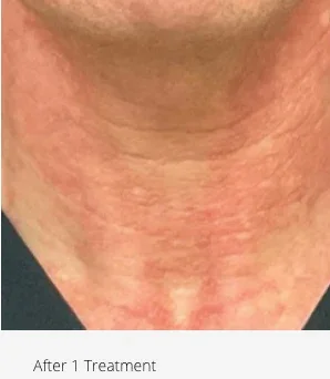 After: neck after 1 DermaV treatment
