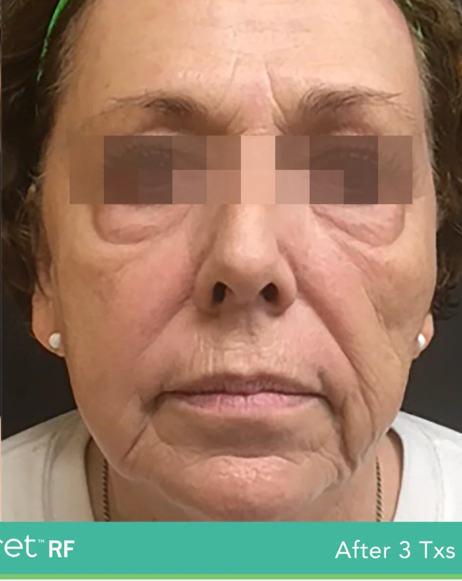 After: face after 3 SecretRF treatments, front view